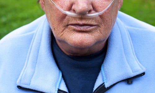 Kvinna med syrgasslang i näsan. Bilden gestaltar att röstprov avslöjar KOL
